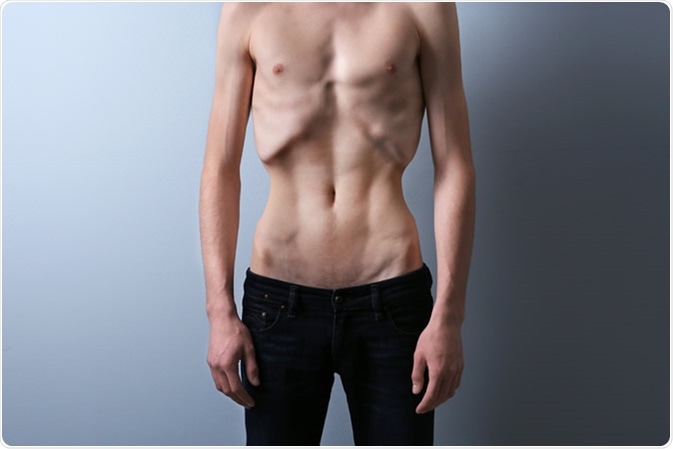 Although it tends to be the most well known eating disorder, anorexia is actually not the most common. According to the Center for Behavioral Health Statistics and Quality, among adults, bulimia and binge eating disorder (BED) are far more common, with anorexia occurring in less than 0.1% of the U.S. adult population.